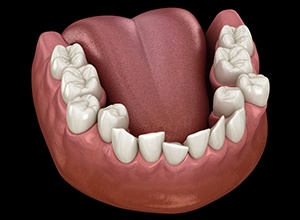 Illustration of crooked teeth