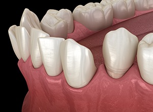 Illustration of gapped teeth
