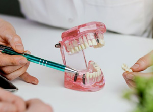 Dentist pointing to a model of an implant bridge
