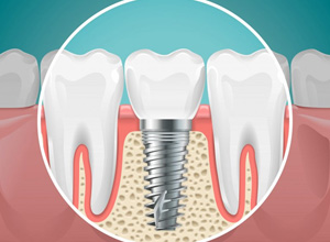 Graphic of a dental implant secured to the jawbone