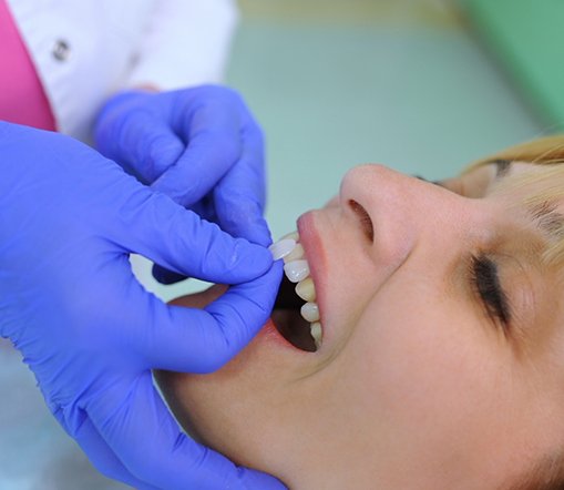 Placing veneer on patient's upper teeth