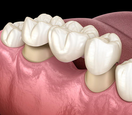 Illustration of dental bridge in West Palm Beach being placed on teeth