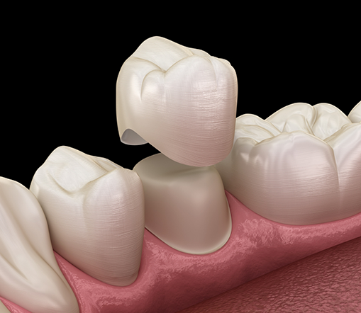 Illustration of dental crown being placed on tooth