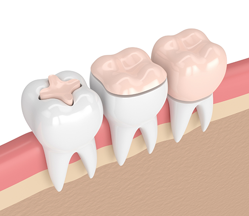 Illustration of teeth with different restorations