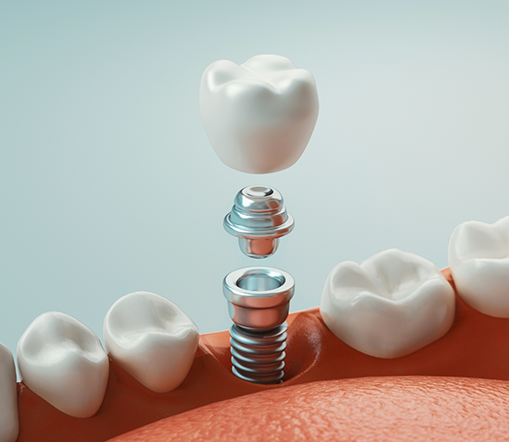 Illustration of dental implant and crown being inserted into jaw