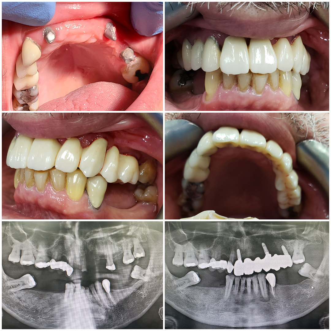 Dental Implants Before and After 1