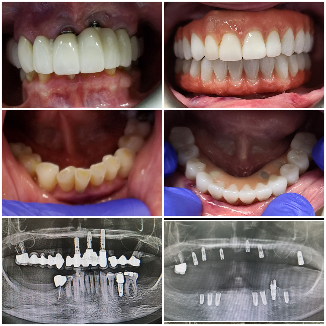 Dental Implants Before and After 2