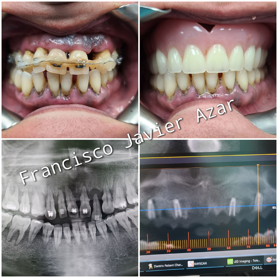 Dental Implants Before and After 3