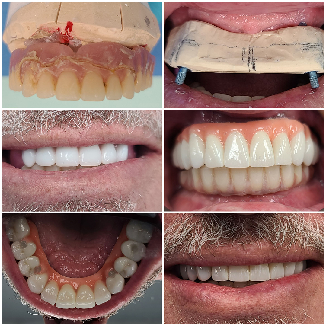 Dental Implants Before and After 4