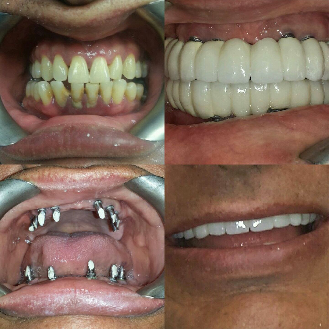 Dental Implants Before and After 7