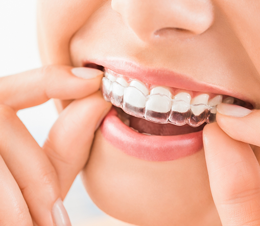 Smiling person putting in Invisalign aligner