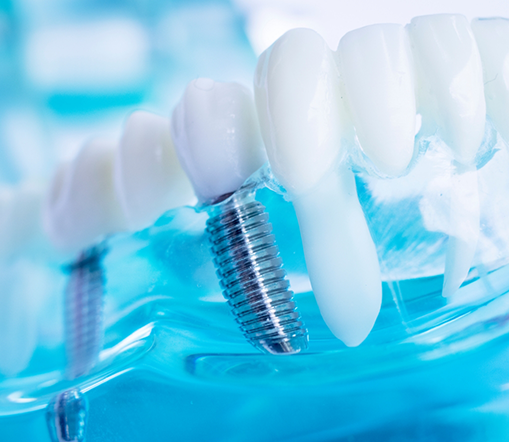 Close up of dental implants in plastic tray