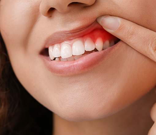 Woman pulling up lip to show inflamed gums