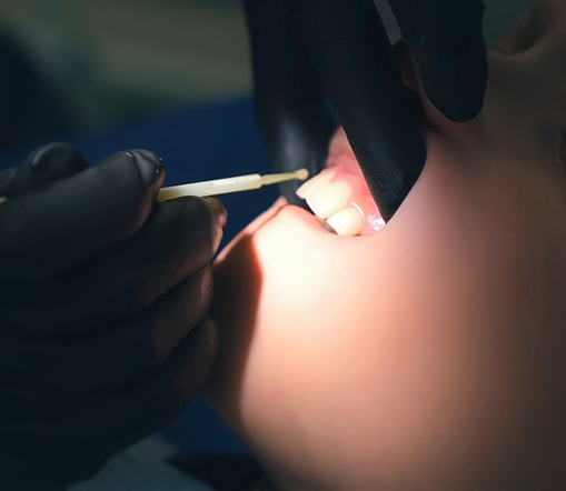 Closeup of patient's mouth during fluoride treatment