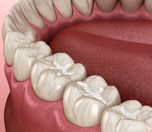 Illustration of dental sealants on lower teeth