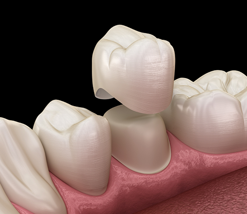 Illustration of dental crown being placed on tooth