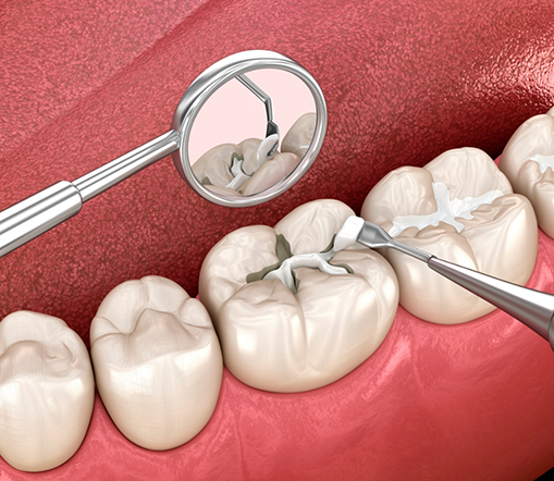 Illustration of fillings being applied to tooth