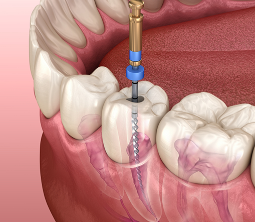 Illustration of root canal treatment in West Palm Beach