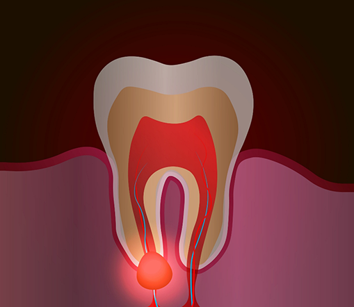 Illustration of an abscessed tooth