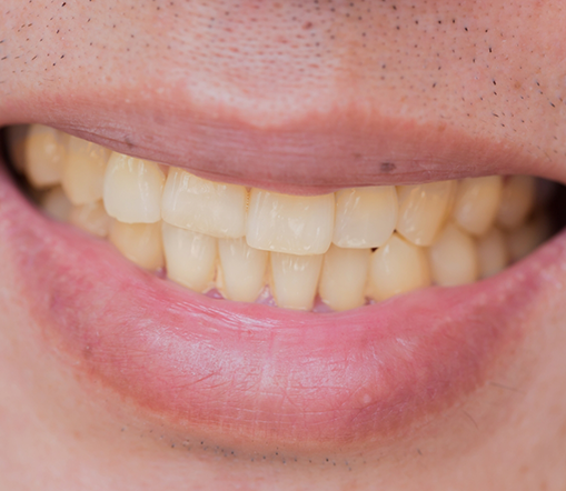 Close up of smile with discolored teeth