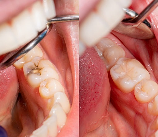 Teeth before and after having fillings placed