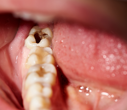 Close up of badly decayed tooth in mouth