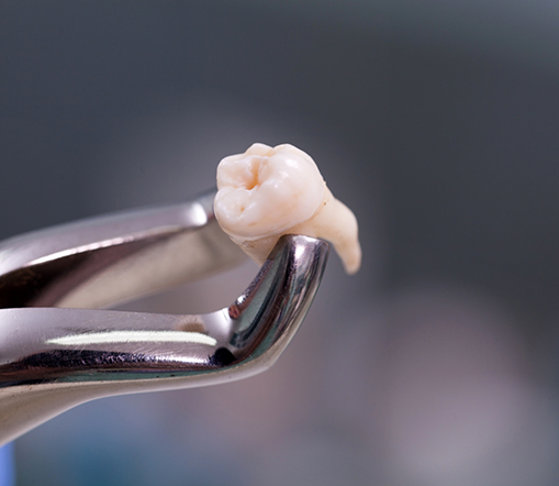 Close up of tooth held by forceps